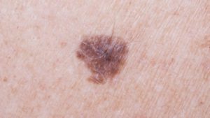 _861684104-mole-spl