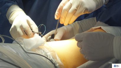 Angioplastie de fistulă arteriovenoasă realizată în premieră la Arad!