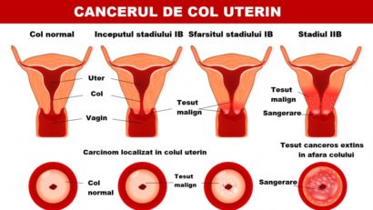 Sprijinul psihologic esenţial în tratarea cancerului de col uterin!